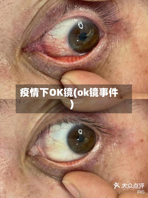 疫情下OK镜(ok镜事件)-第2张图片